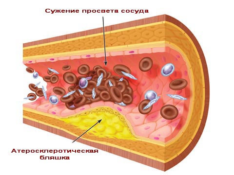 Питание при атеросклерозе аорты сердца