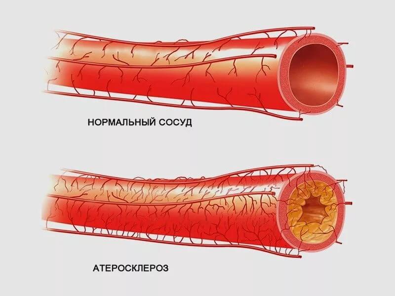 Что такое атеросклероз венечных сосудов сердца?